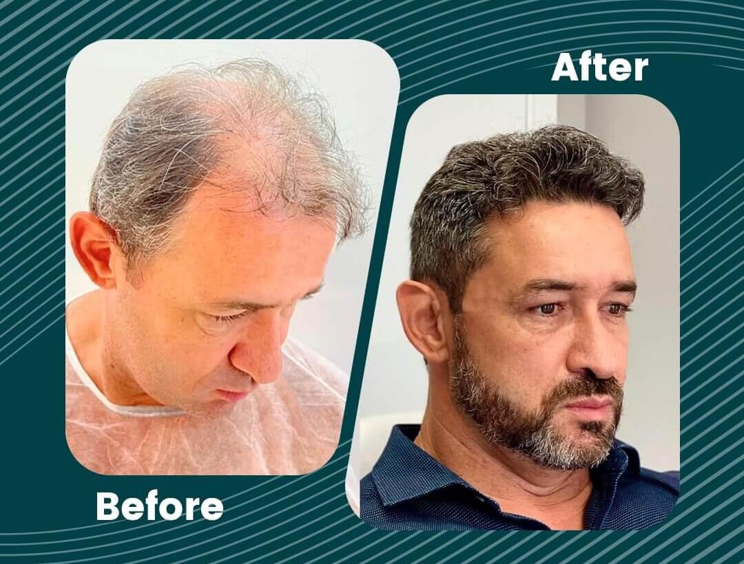 Hair Transplant Turkey Before and After