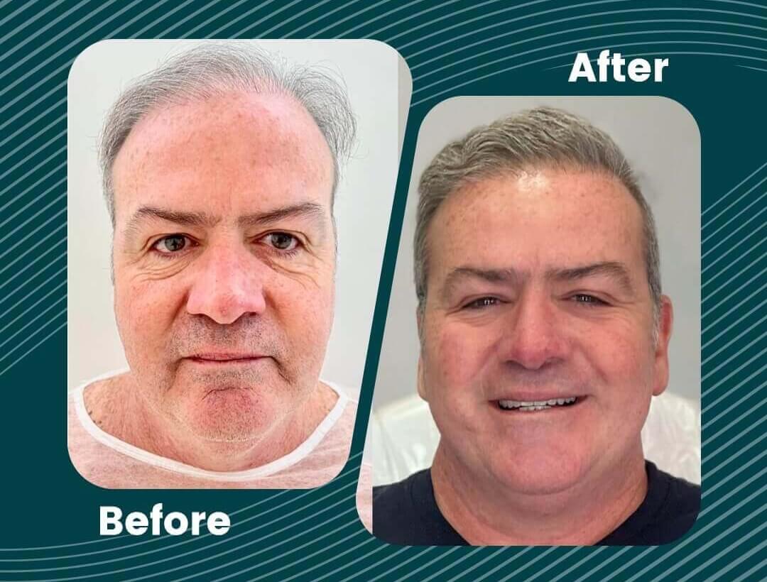 Hair Transplant Turkey Before and After