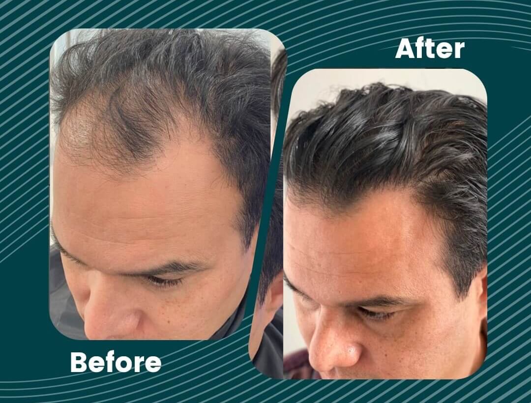 Hair Transplant Turkey Before and After