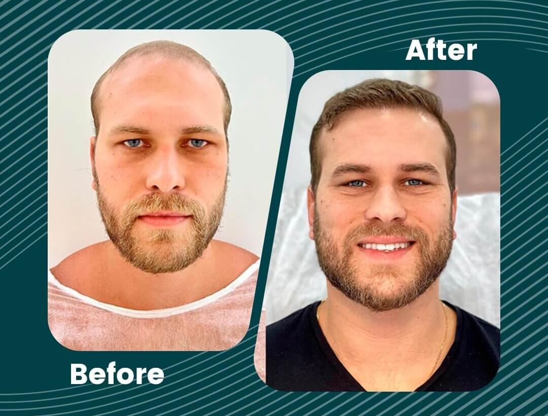 Hair Transplant Turkey Before and After