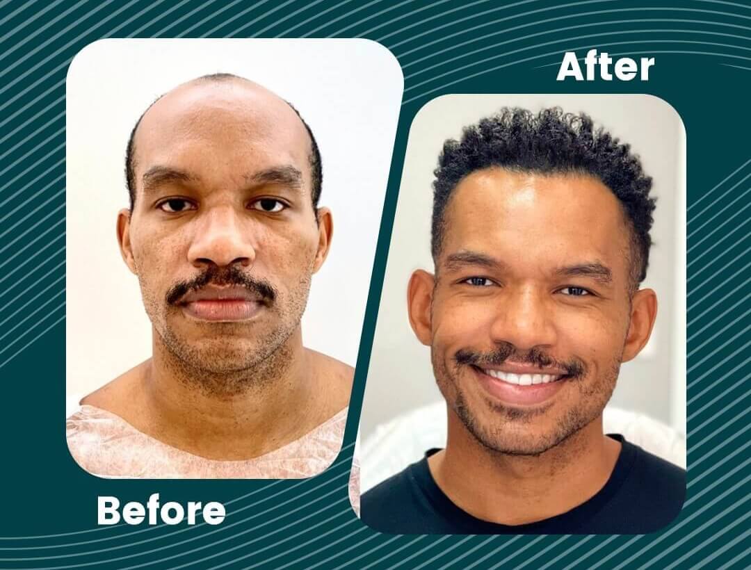 Hair Transplant Turkey Before and After