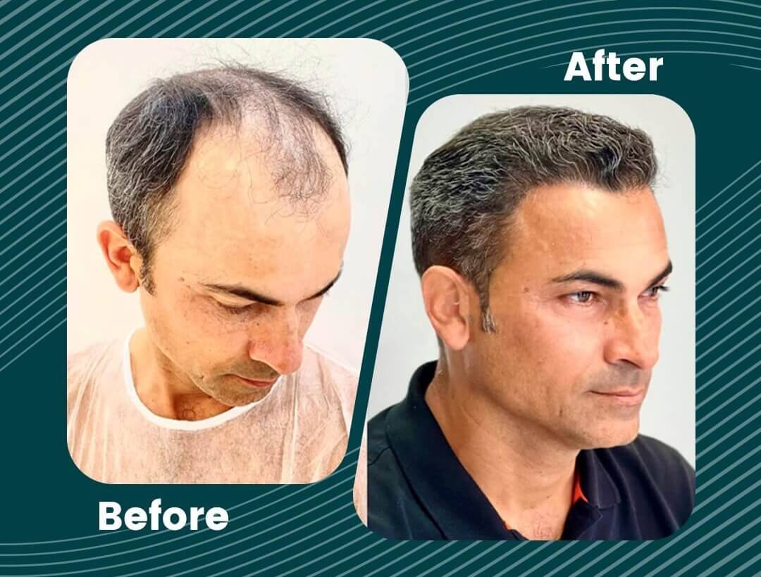 Hair Transplant Turkey Before and After