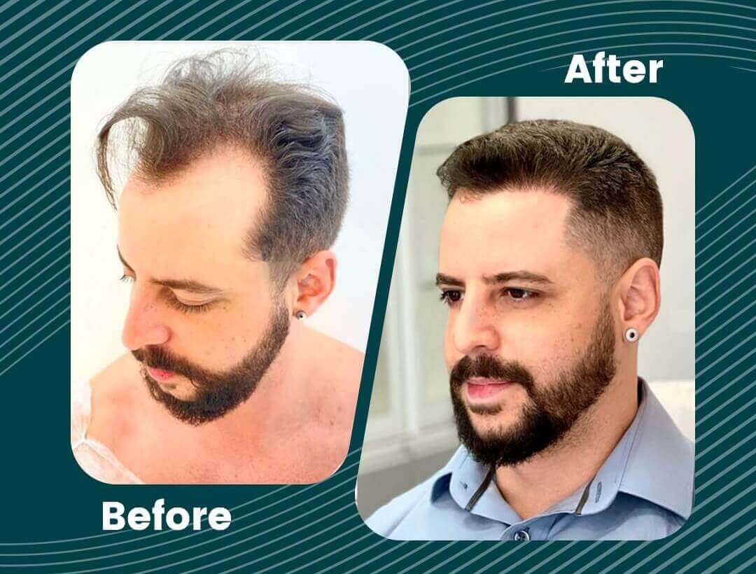 Hair Transplant Turkey Before and After