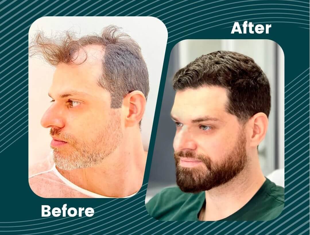 Hair Transplant Turkey Before and After