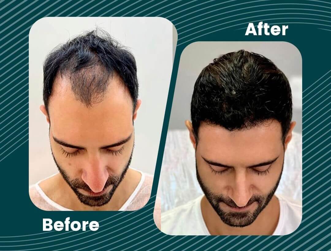 Hair Transplant Turkey Before and After