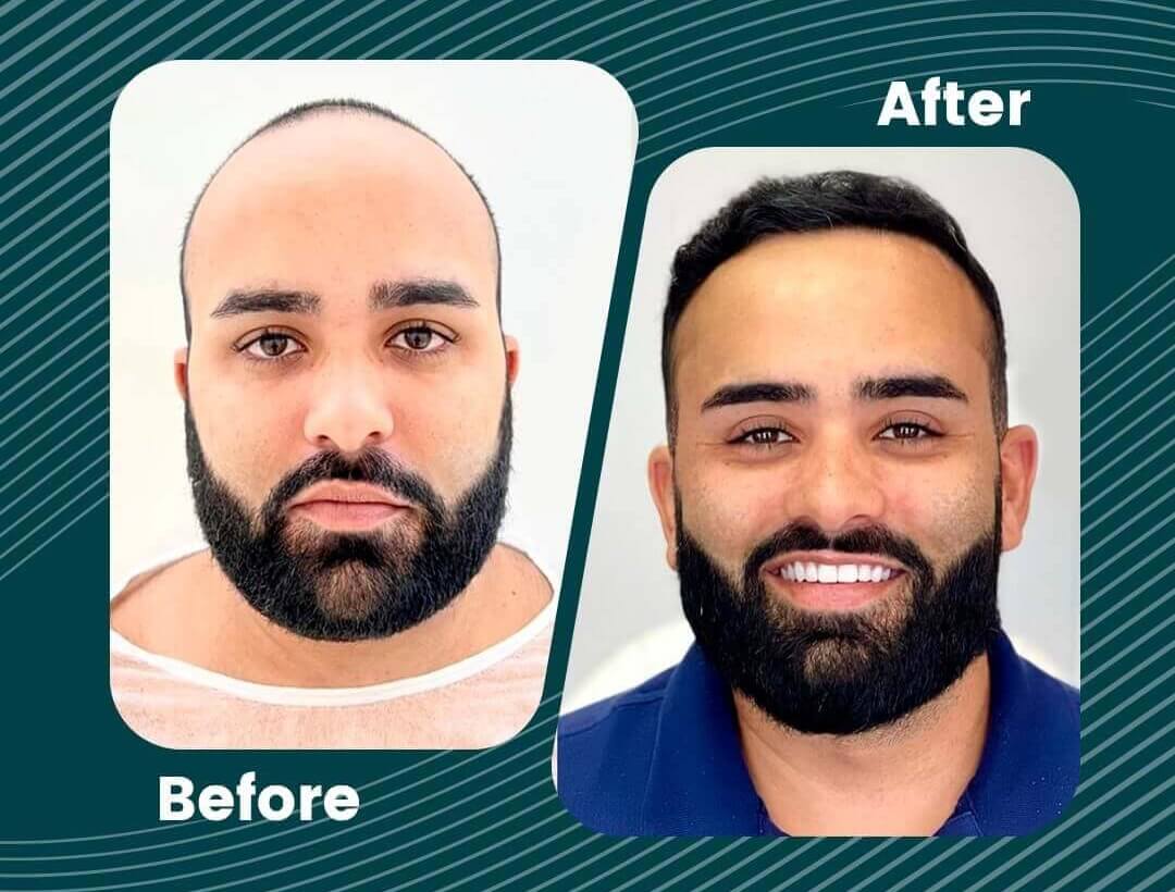 Hair Transplant Turkey Before and After