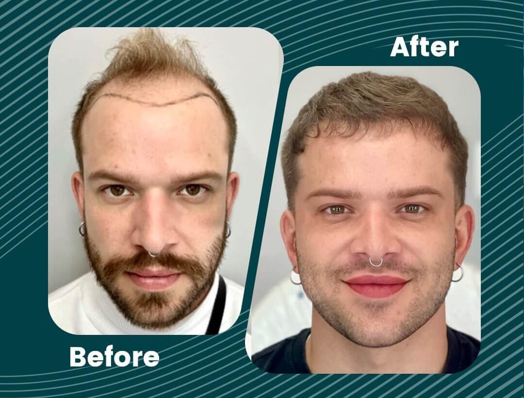 Hair Transplant Turkey Before and After