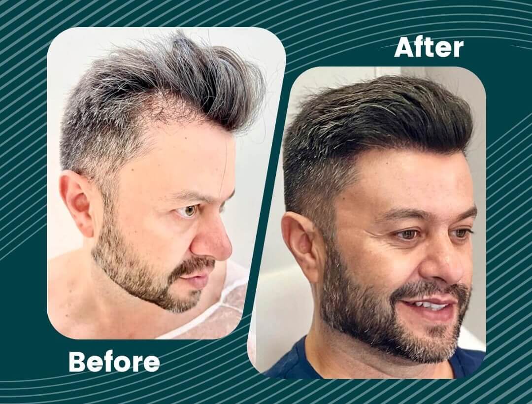 Hair Transplant Turkey Before and After