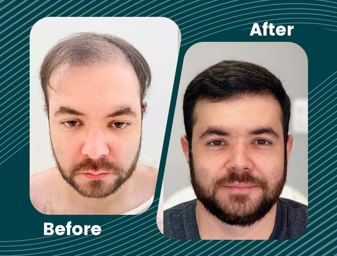 Hair Transplant Turkey Before and After