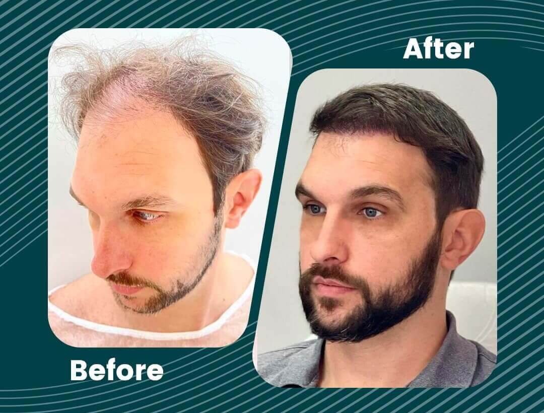 Hair Transplant Turkey Before and After